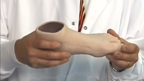 Custom Fabrication of a Silicone Partial Foot Prosthesis